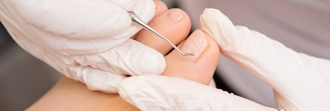 Ingrown Toenails and Nail Surgery