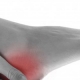 Treatment of Heel Pain Plantar Fasciitis