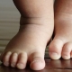 Children Podiatry