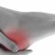 Heel Pain