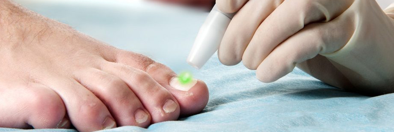 Fungal Nail Laser Treatment