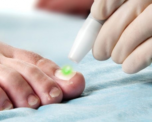 Fungal Nail Laser Treatment