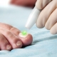 Fungal Nail Laser Treatment