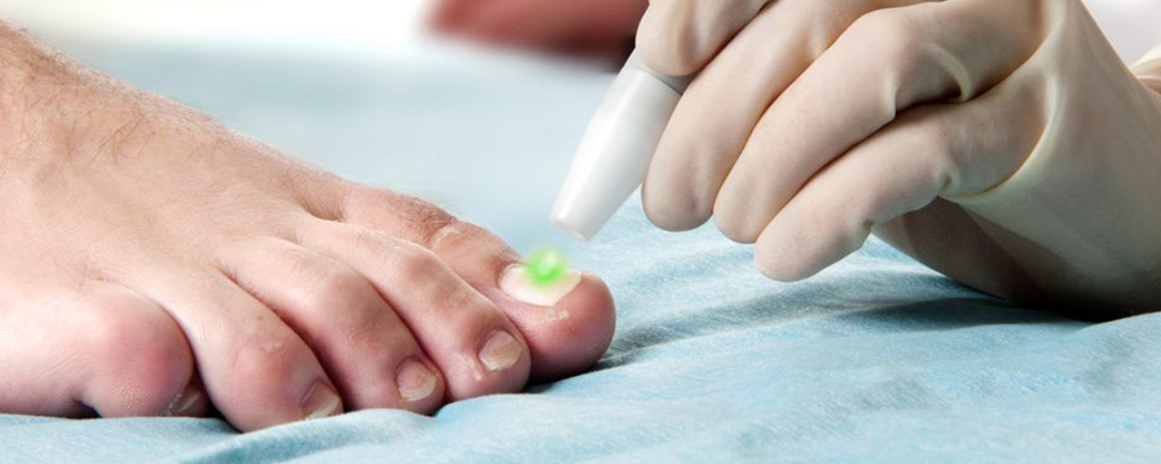 Fungal Nail Laser Treatment